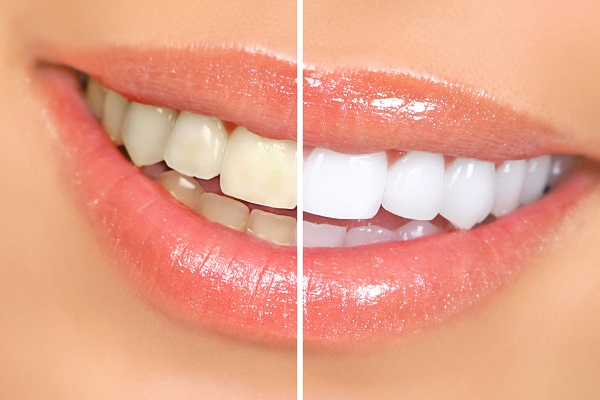 What Is Dental Laser Teeth Whitening?